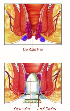 PPH Hemorrhoidopexy 1