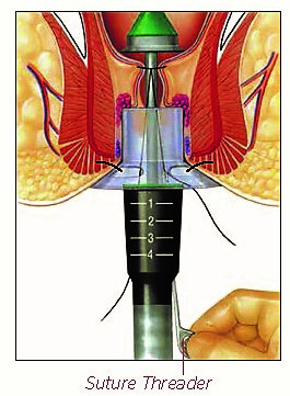 PPH Hemorrhoidopexy 3