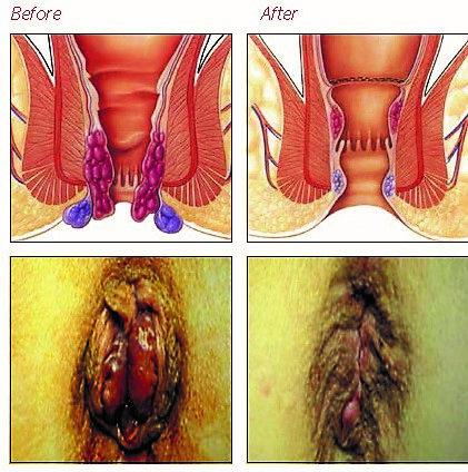 PPH-Hemorrhoidopexy