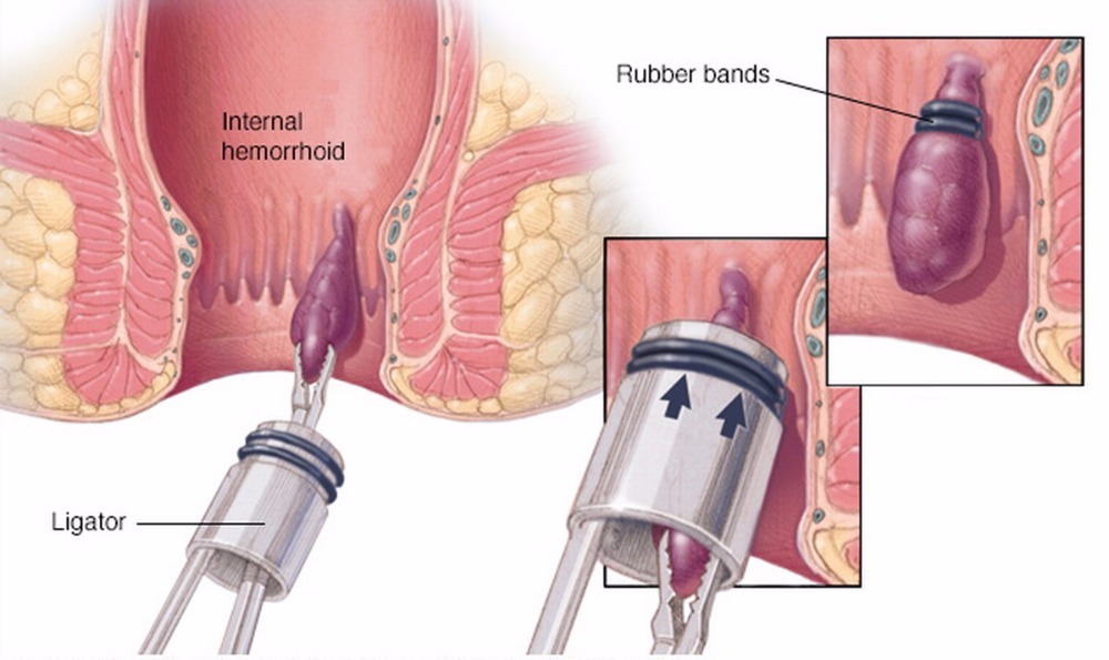 Hemorrhoid Treatment 1