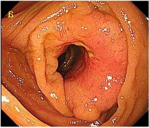 Colon cancer