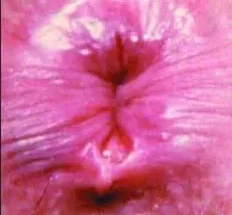 Anal Fissure