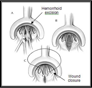 Hemorrhoidectomy