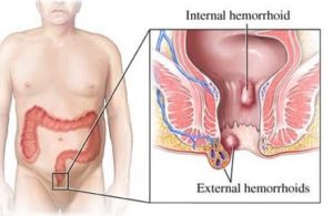 Hemorrhoid FAQ 1